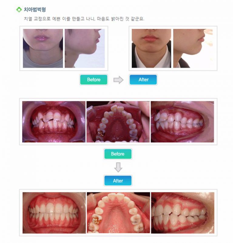 치아범벅형
