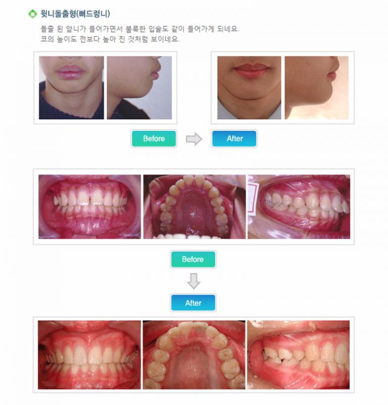 윗니돌출형(뻐드렁니)