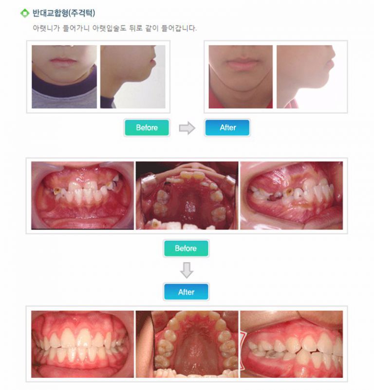 반대교합형(주걱턱)