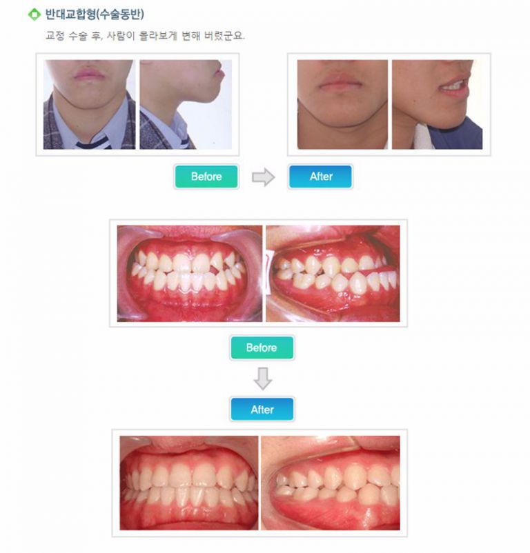 반대교합형(수술동반)