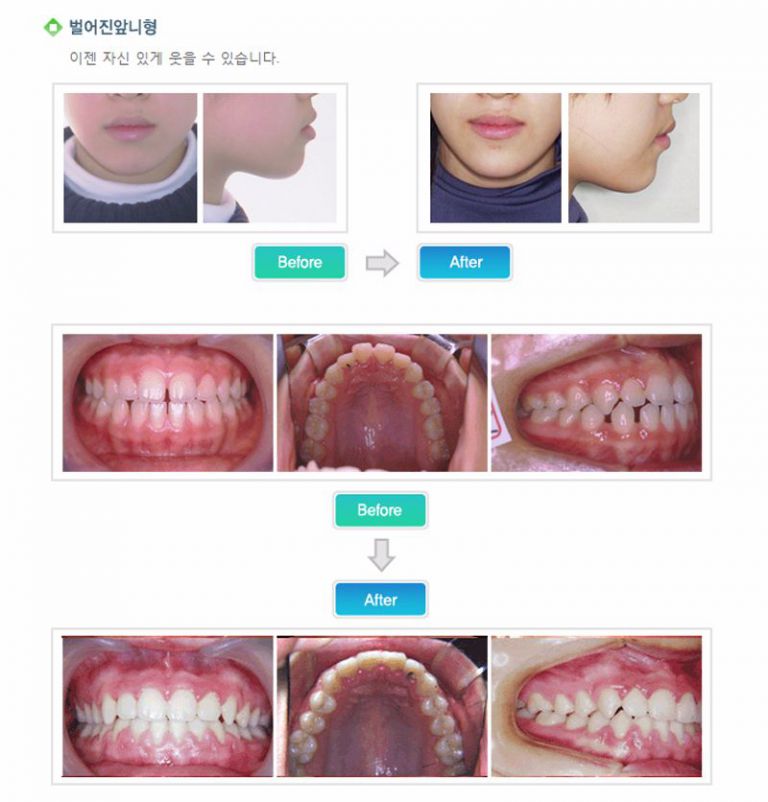 벌어진앞니형