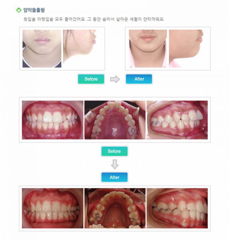 양악돌출형